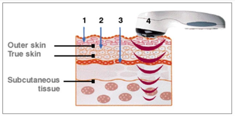 Therapeutic Ultrasound