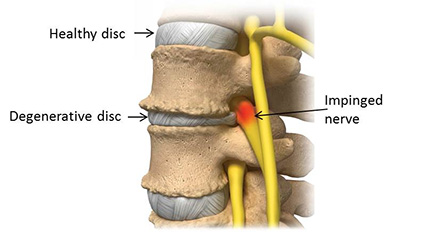 Degenerative Disc Disease